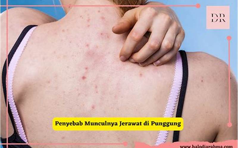 Cara Membersihkan Jerawat Di Punggung