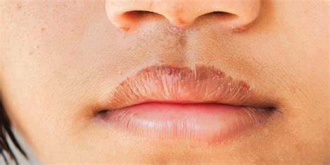 Bibir Gatal Bikin Sebal? Kenali 6 Penyebabnya Ini