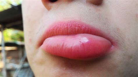 Cara Mengatasi Herpes Cara Mengatasi Gatal Di Bibir