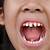 Cara Mengatasi Gigi Berlubang Pada Anak Usia 5 Tahun