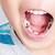 Cara Mengatasi Gigi Berlubang Pada Anak