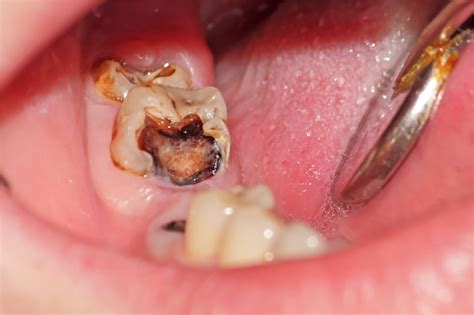 Cara Mengatasi Gigi Berlubang Pada Anak Usia 4 Tahun
