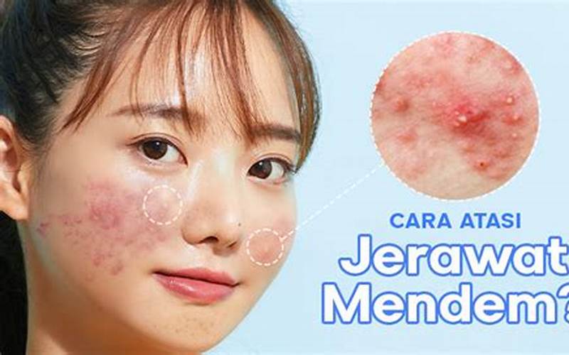 Cara Mengatasi Jerawat Keturunan