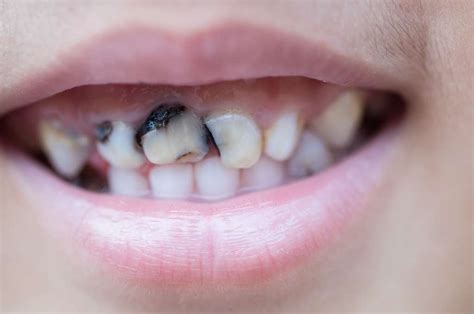 Cara Menghilangkan Gigi Berlubang Hitam Secara Alami
