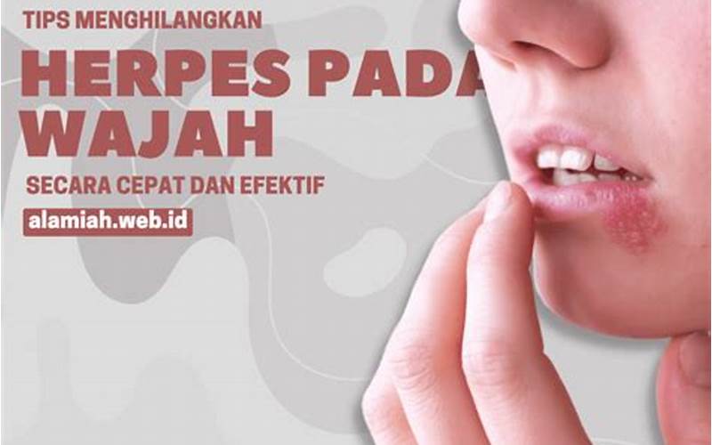 Cara Menghilangkan Herpes: Tips Alami Dan Efektif