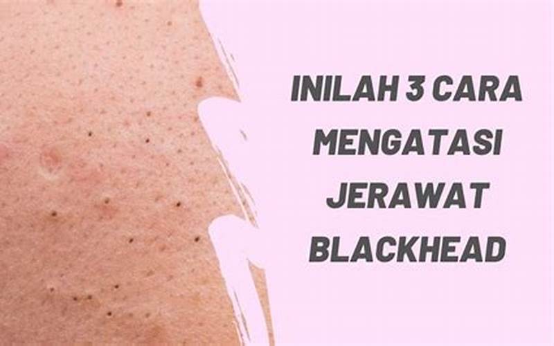 Cara Menghilangkan Jerawat Blackhead Secara Alami