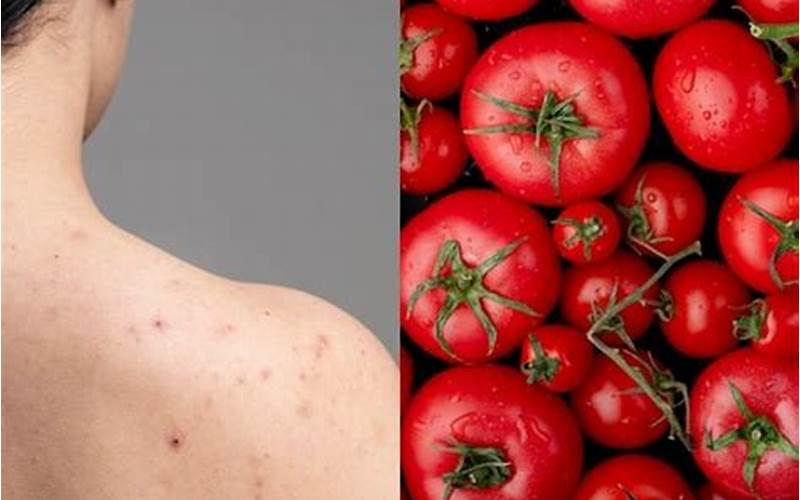 Cara Menghilangkan Jerawat Di Punggung Dengan Tomat