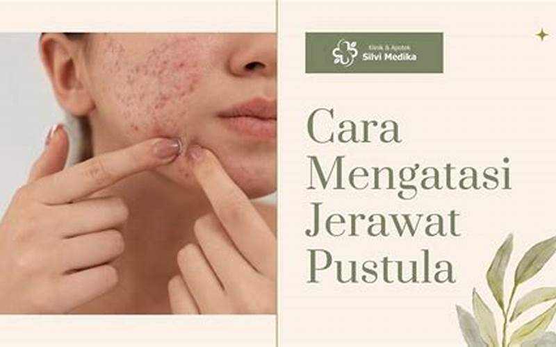 Cara Menghilangkan Jerawat Pustula Secara Alami