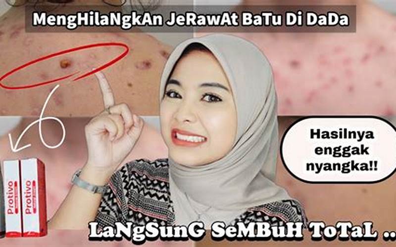 Cara Menghilangkan Jerawat Selamanya