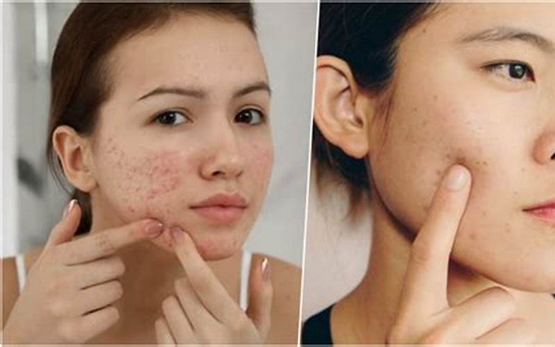 Cara Menghilangkan Kemerahan Bekas Jerawat Dengan Skincare