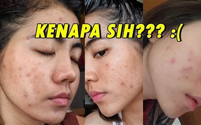 Cara Menghilangkan Merah Di Pipi Bekas Jerawat