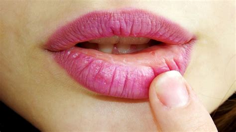 BIBIR KERING Inilah Penyebab Bibirmu Kering dan Cara