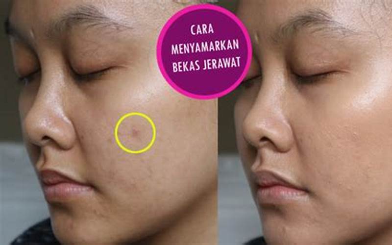 Cara Menyamarkan Jerawat Dengan Make Up