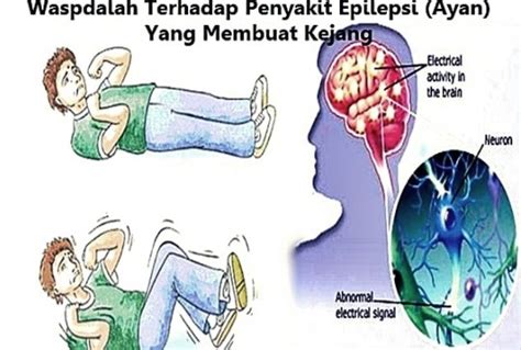 Cara Menyembuhkan Epilepsi Pada Orang Dewasa