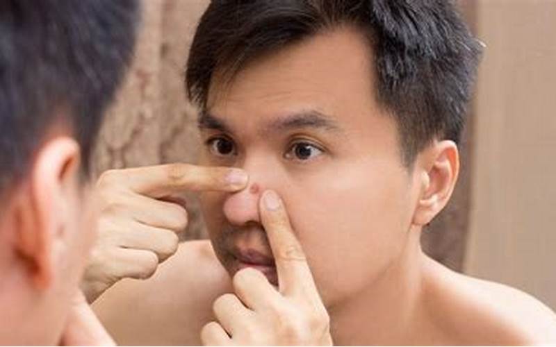 Cara Meredakan Jerawat Di Hidung