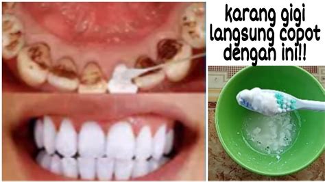Cara Mencegah Karang Gigi