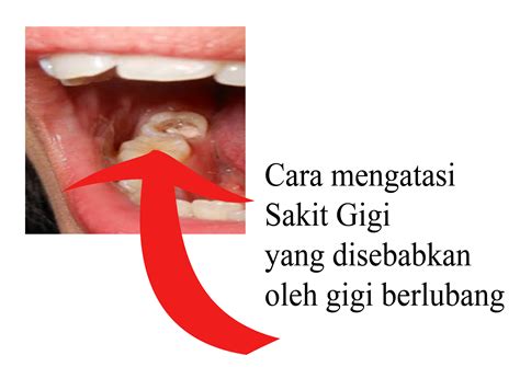 Cara Mengatasi Sakit Gigi di Indonesia