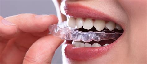 Cara Mengetahui Harga Clear Aligners