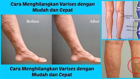 Cara Menghilangkan Varises