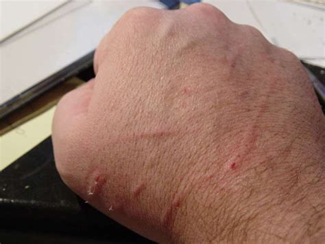 CatScratch Disease Causes, Symptoms and Treatment