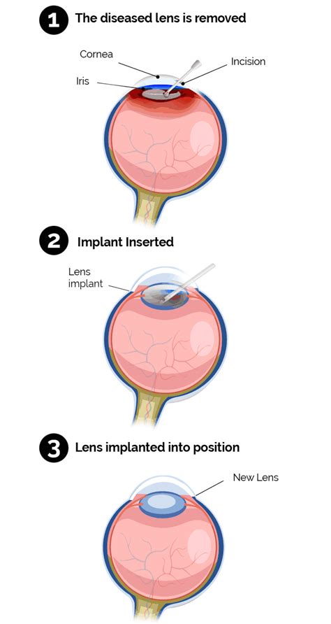 Cataract Management