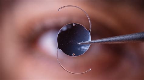 Cataract Surgery: Restoring Sharp Focus