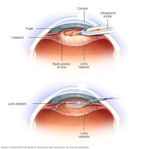 Cataract Surgery: The Most Common Procedure