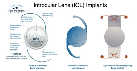 Cataract Surgery and Lens Implants