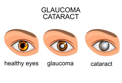 Cataracts: Types, Symptoms & Prevention Tips