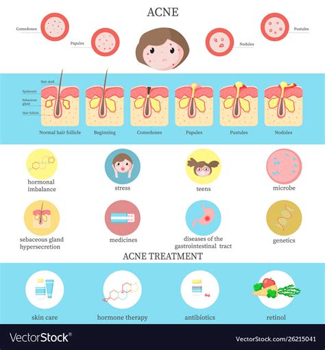 Acne types causes and treatment infographics Vector Image