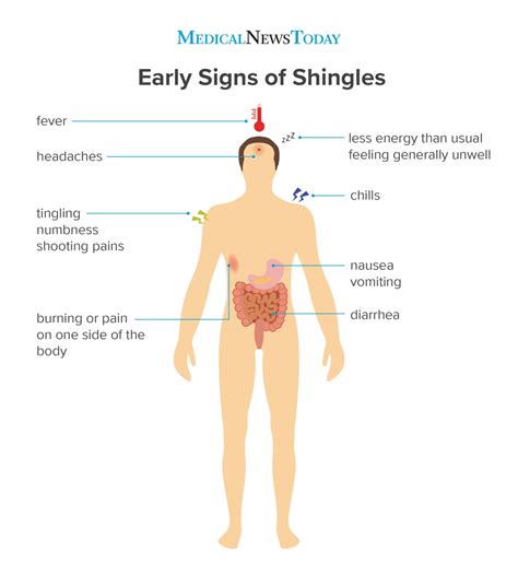 Causes of Shingles Outbreaks