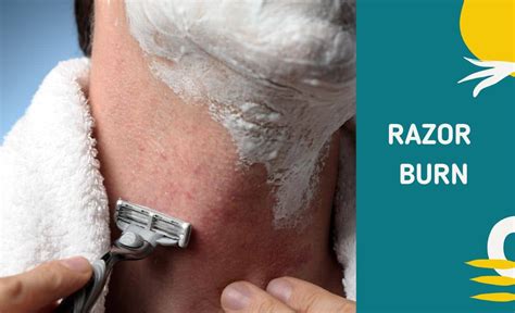Causes of razor burn