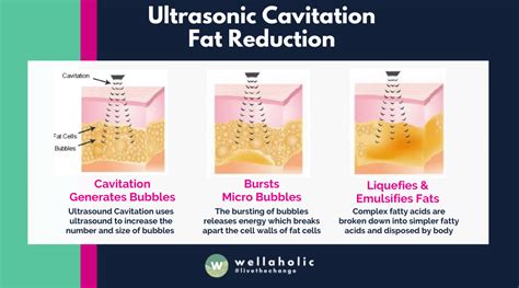 Cavitation Therapy for Fat Reduction