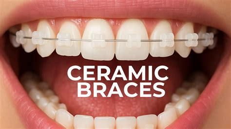 Ceramic Braces Cost