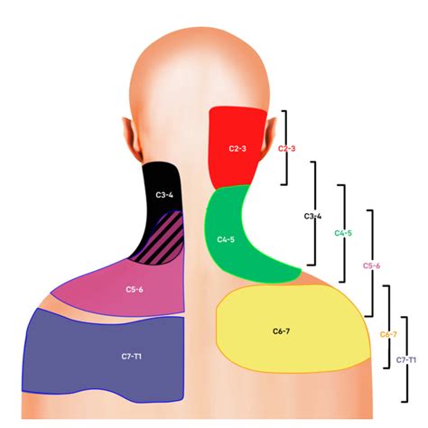 Cervical Disc Referral Patterns