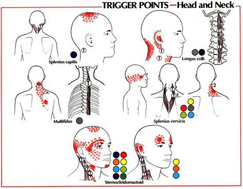 Cervical Referral Patterns