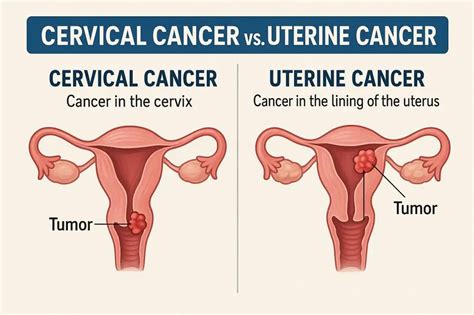 Cervical vs. Uterine Cancer: Key Differences Explained.