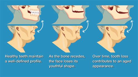 Changes in Jaw Structure