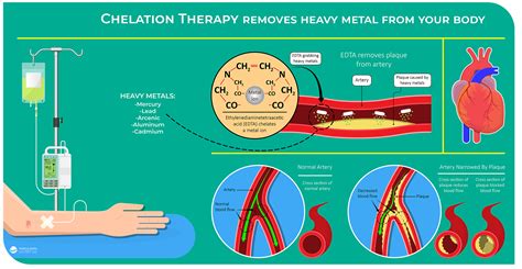Chelation Therapy Explained
