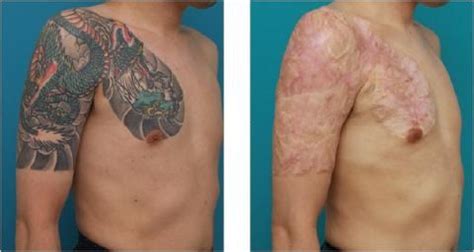 Tattoo Removal Before & After Delete Tattoo Removal