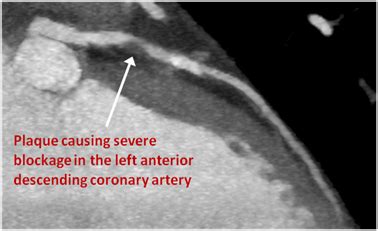 Artery Blockage