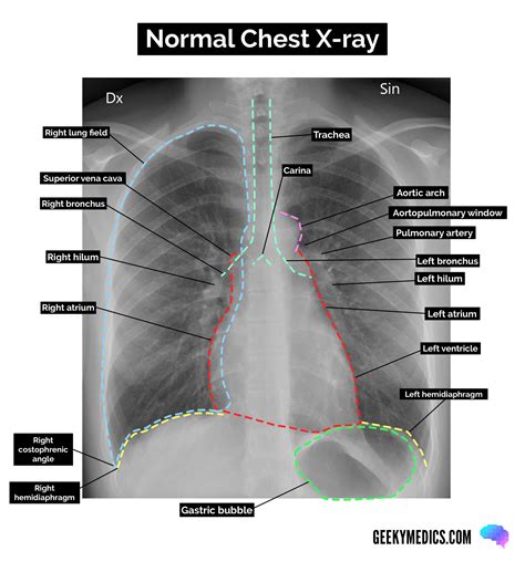 Chest X-Ray Limitations and Additional Diagnostic Tools
