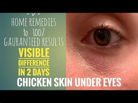 The Unveiling of Chicken Skin Under Eye: Decoding the Mystery behind this Common Skin Concern