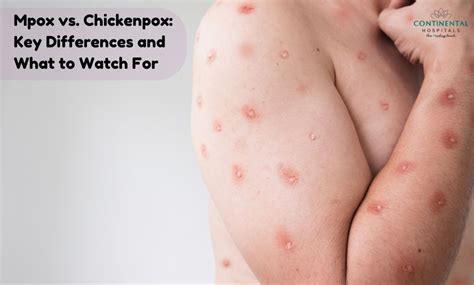 Chickenpox vs. Monkeypox: Key Differences Explained.