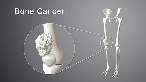 Child Bone Cancer: Signs, Types & Action