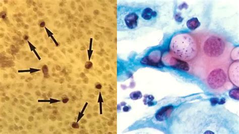 Chlamydia Under Microscope: Diagnostic Process