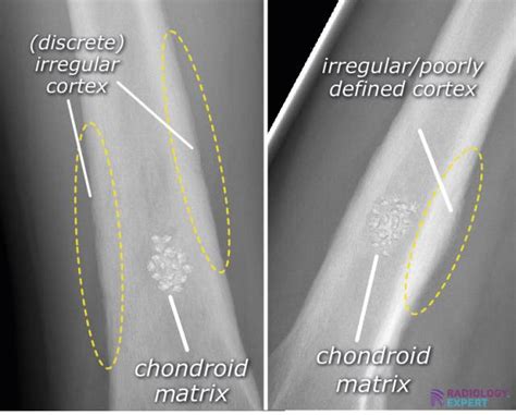 Chondroid Lesion Definition
