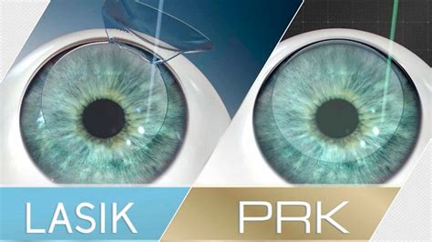 Choosing Between LASIK and PRPL