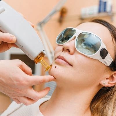 Choosing the Right Removal Method