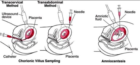 Chorionic Villus Sampling test and interpretation